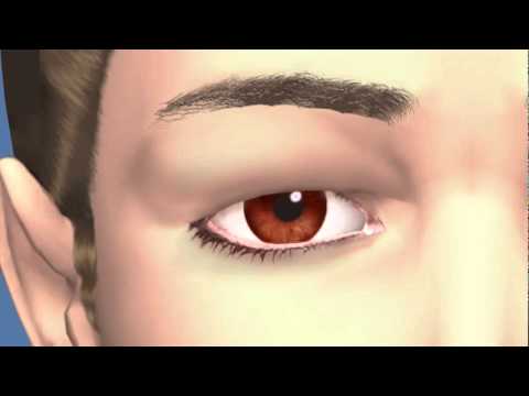 Eyelid Dermatochalasis