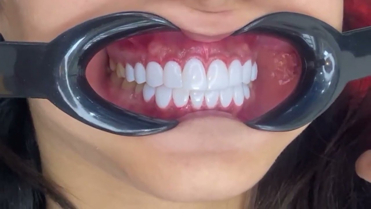 Female's Teeth | Makeover 4 Smile
