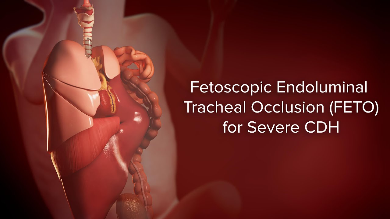Fetoscopic Endoluminal Tracheal Occlusion (FETO) for Severe CDH