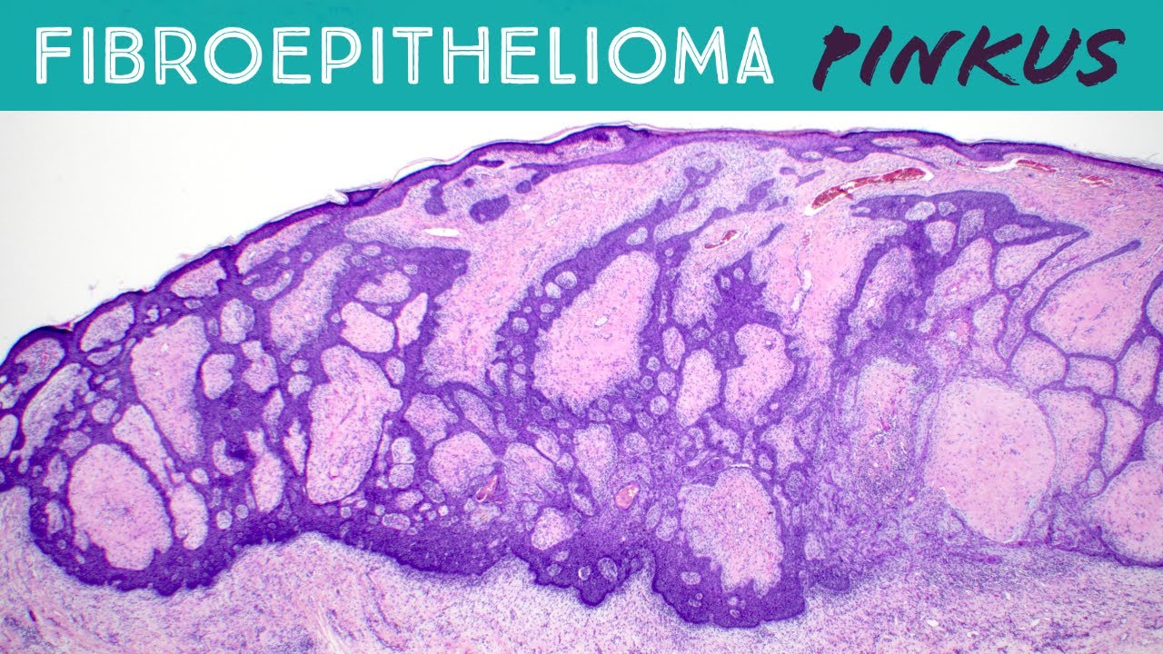Fibroepithelioma of Pinkus (basal cell carcinoma subtype vs hair follicle tumor) dermpath pathology