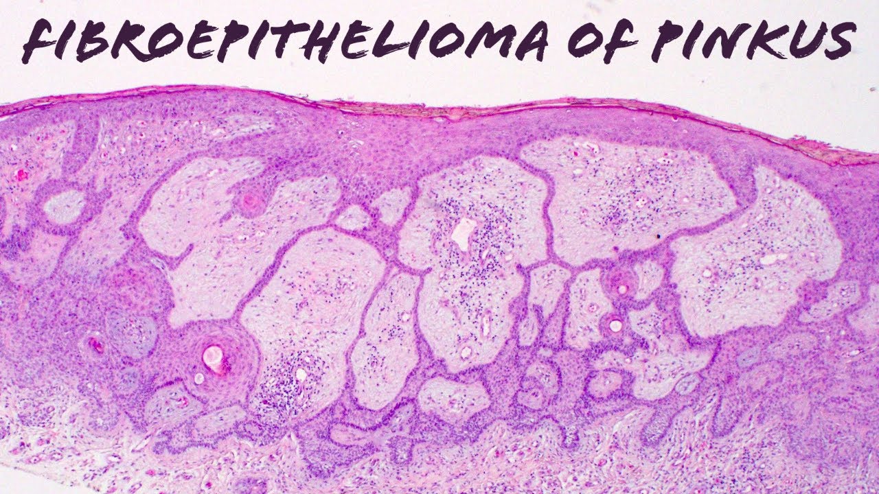 Fibroepithelioma of Pinkus (BCC or not?)
