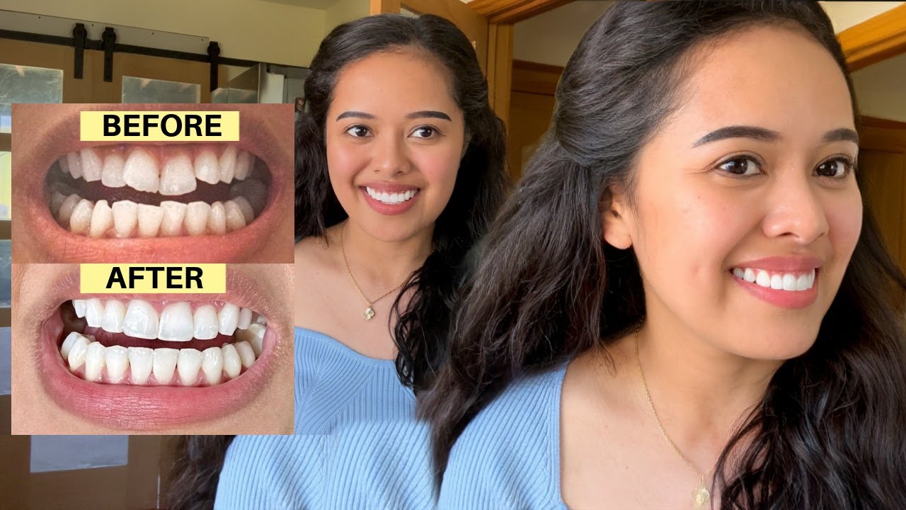 FILIPINA BRITISH LIFE IN UK: INVISALIGN JOURNEY! MAG KANO ANG NAGASTOS?