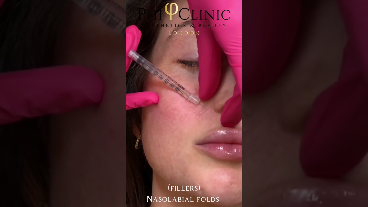 Fillers for Nasolabial Folds