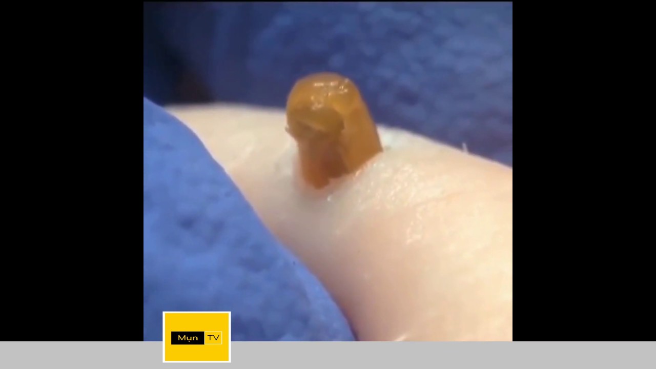 F***ing huge blackhead removal collection * Tổng hợp video nặn mụn khủng khiếp*
