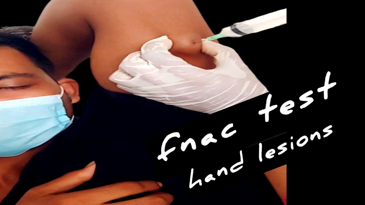 FNAC in Diagnosing Lesions Of Hand।।