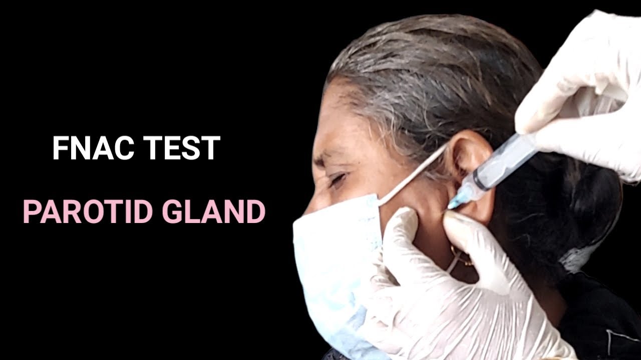 FNAC in The Diagnosis of Lesions in Parotid Gland ।।
