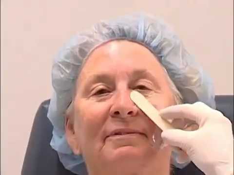 Fractional CO2 laser eco2 Lutronic