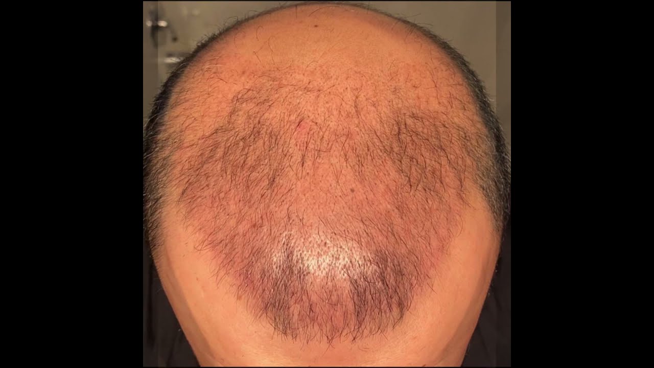 FUE Hair Transplant-  [ 14 weeks result ] 4300 graft - Dr. Serkan Aygın Clinic
