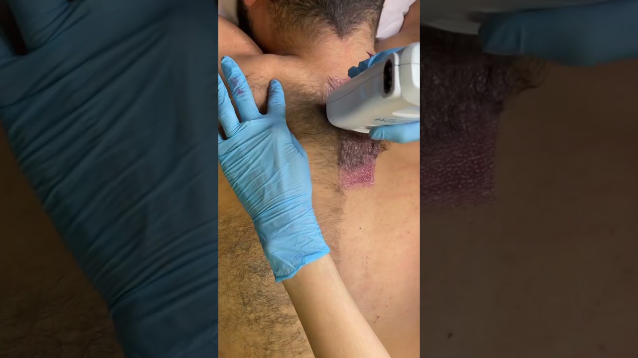 Full Back Waxing Hair Removal for Men #shorts