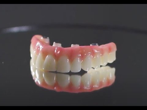 Full Mouth Dental Implants. What You Should Know and Cost