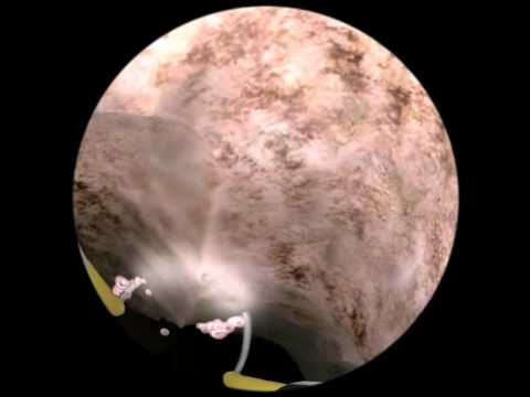 Full TURP procedure (Cutouts)