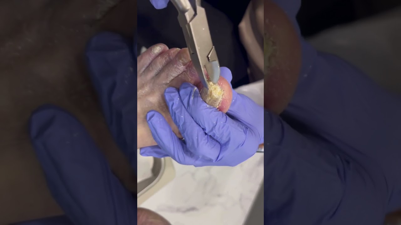 Fungal Trim #clips #podiatry #fungus #nails #feet #toenails