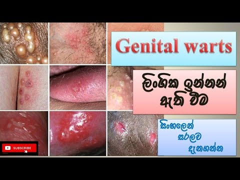 Genital warts/ ලිංගික ඉන්නන්/ how it happens/ causes/ symptoms/ treatment/ how to prevent