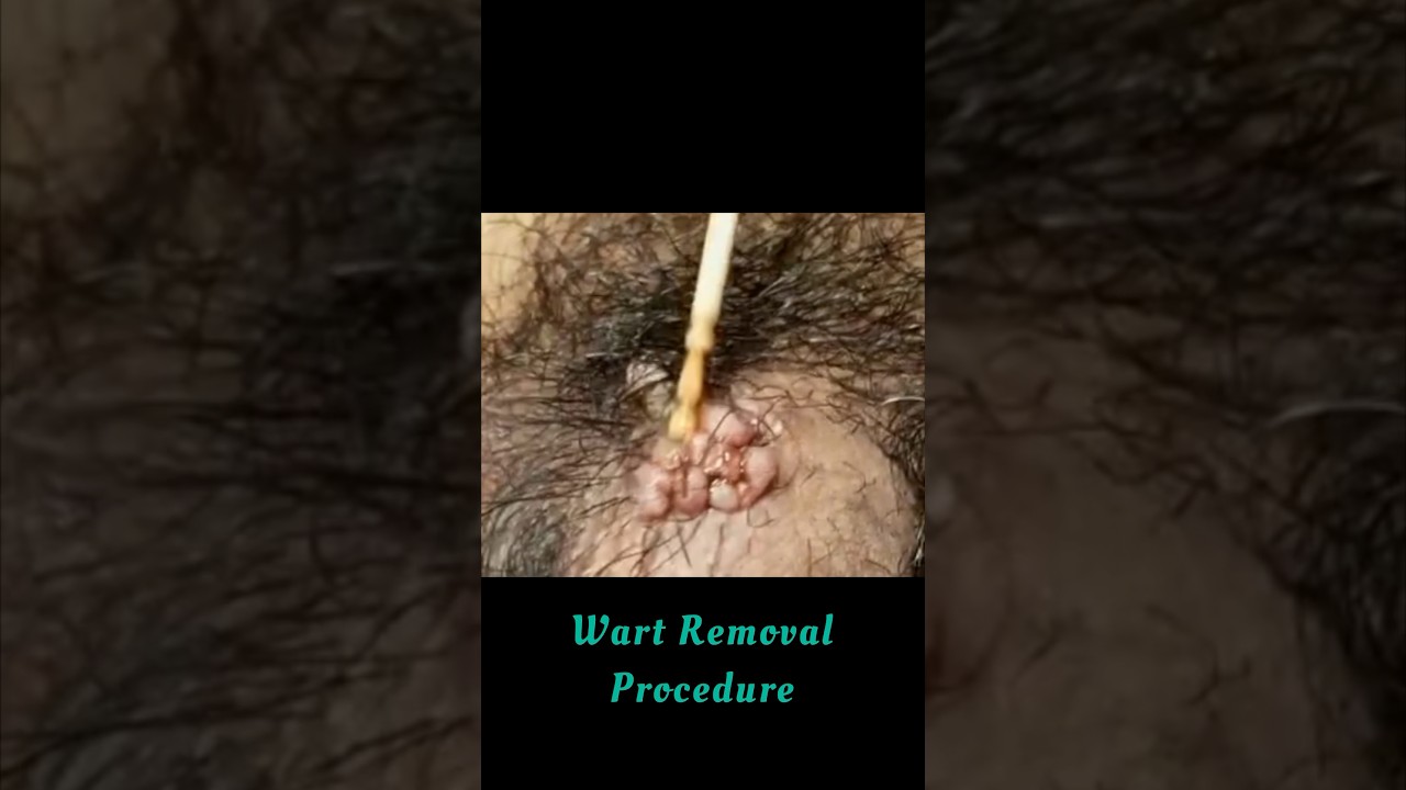 Genital warts Treatment #skincare #drashimagoel #parisaskinclinic #dermatologist