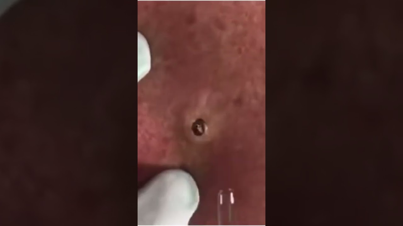 Giant blackheads 👩🏻‍⚕️😁 “Winer's dilated pore”