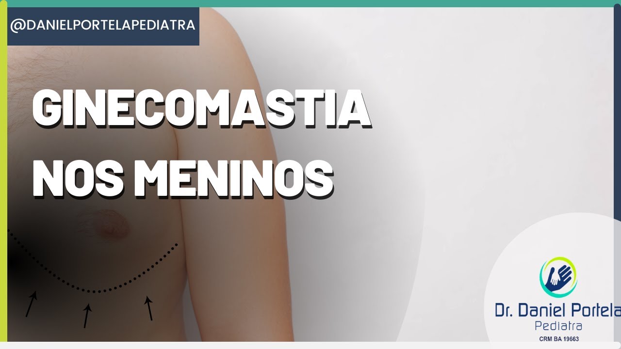 Ginecomastia nos meninos e a preocupação com a imagem do adolescente (carocinho no peito)