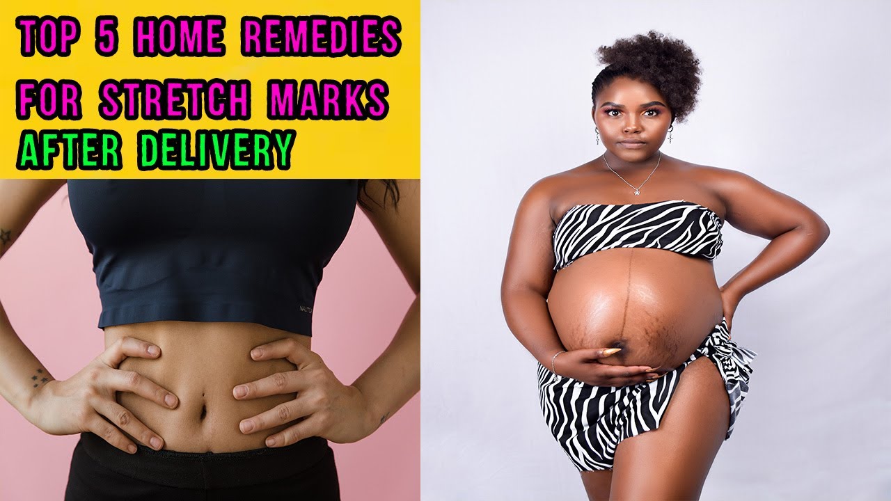 @GLAMRSTV  BEST 5 Effective Home Remedies for Pregnancy Stretch Marks| Stretch Marks after Delivery