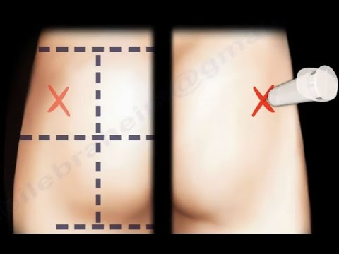 Glute Injection ,Buttock injection - Everything You Need To Know - Dr. Nabil Ebraheim