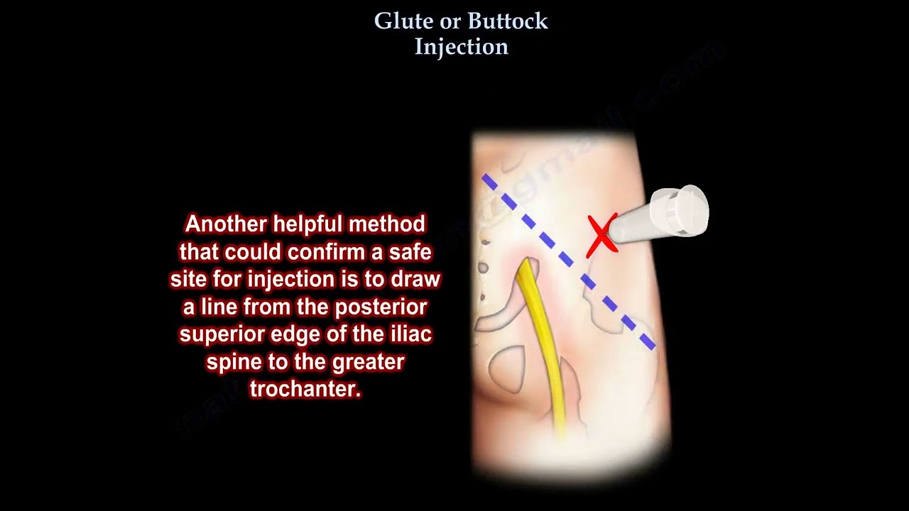 Glute injection, buttock injection