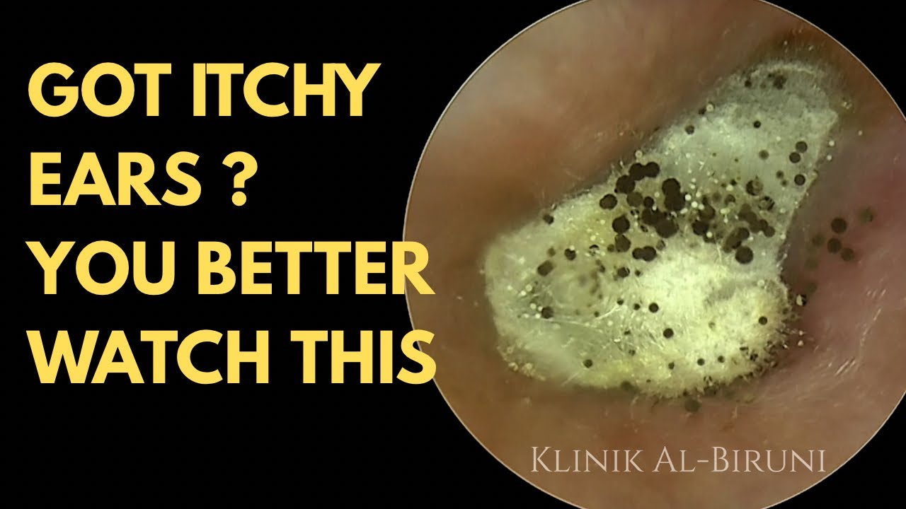 GOT ITCHY EARS? You Better Watch This !!