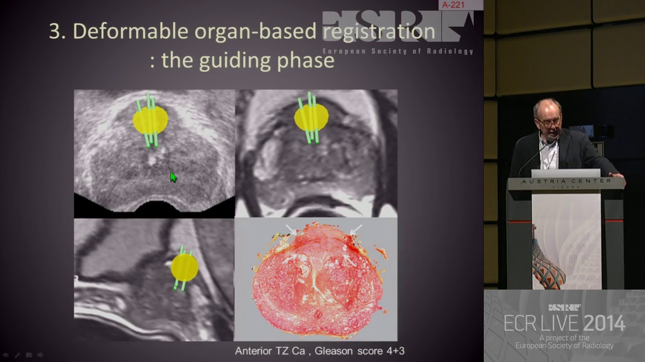 GU - mage guided prostate biopsies   A paradigm shift 5