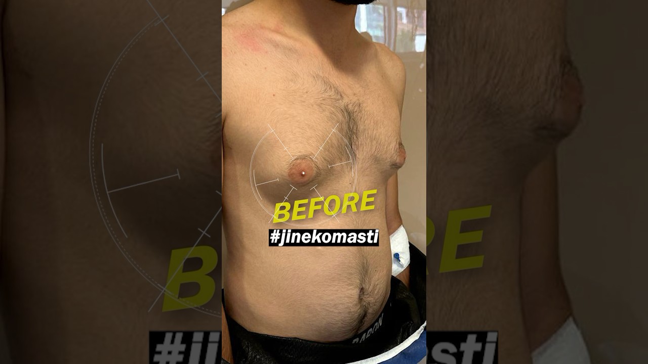 Gynecomasty Surgery Before-After #gynecomastiaresult