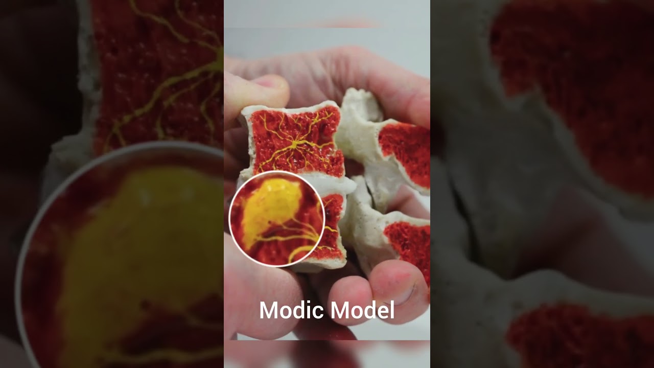 Handcrafted Dynamic Modic Disc Model: Visualizing Pain in the Vertebra