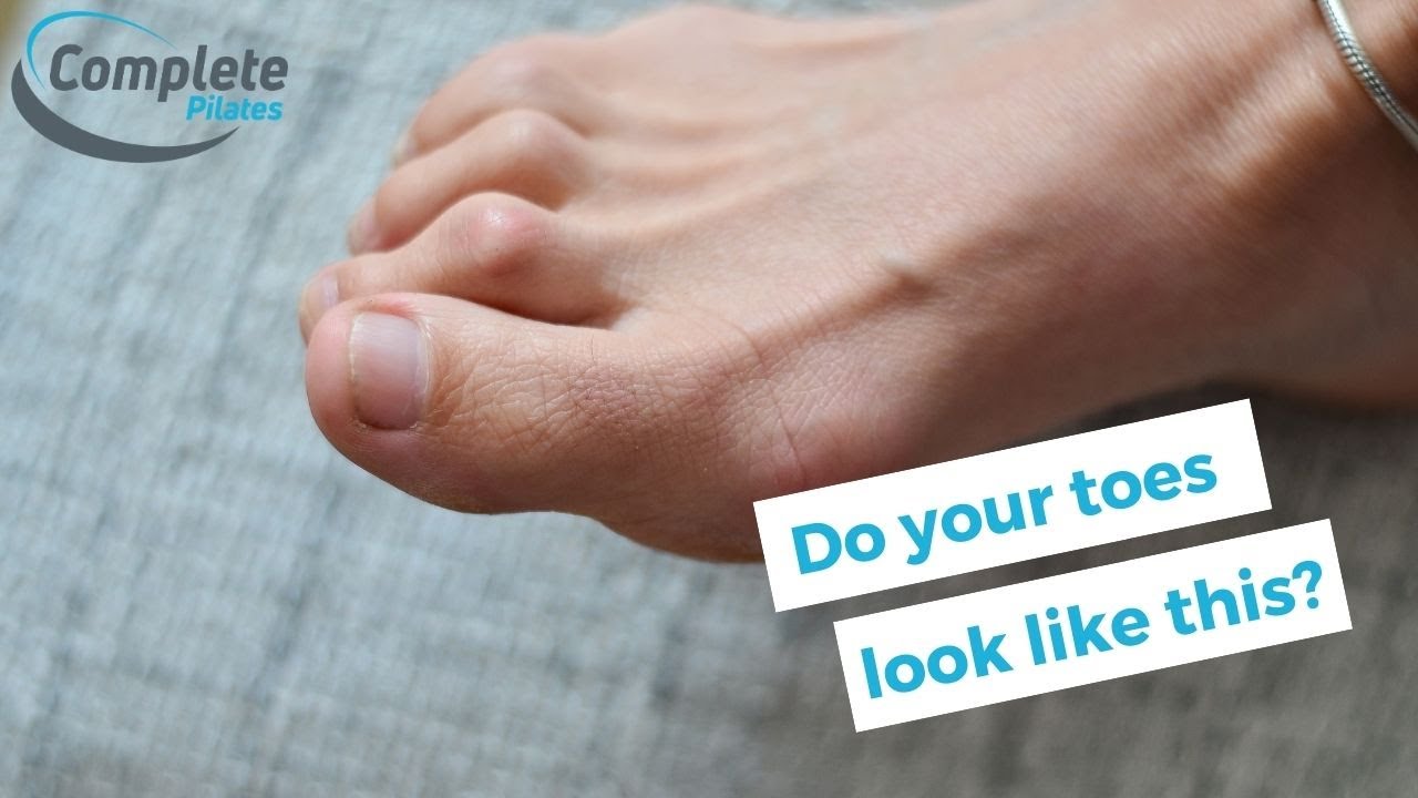 Healthy Feet: what to do for hammer toe