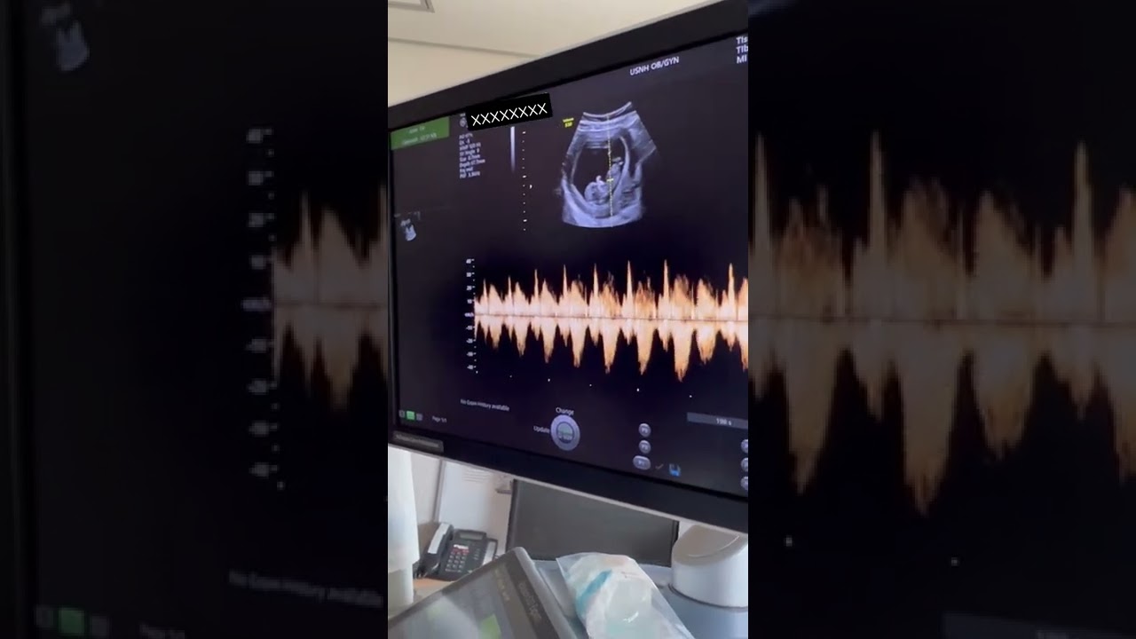 HEARING BABIES HEARTBEAT FOR THE FIRST TIME- 11 WEEKS PREGNANT