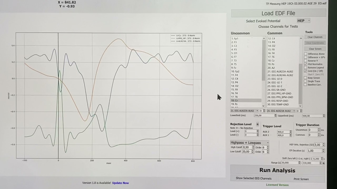 Heart Beat Evoked Potentials (HEPs) measured by IFEN´s new ERP-Analyzer