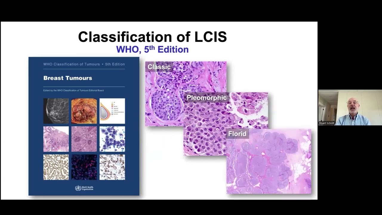 High-Risk Breast Lesions and Breast Cancer