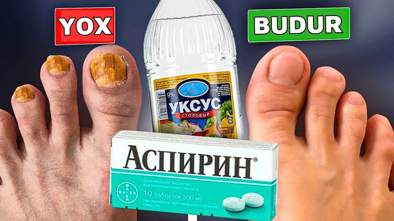 Həkimlərin Dırnaq Göbələyini Məhv Edən GİZLİ SİLAHI - SİRKƏ VƏ ASPİRİN