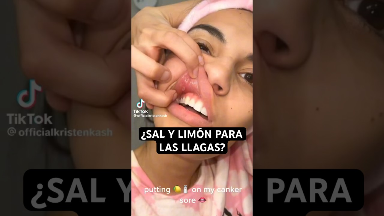 HOME REMEDY for MOUTH SORES - DON'T SUFFER