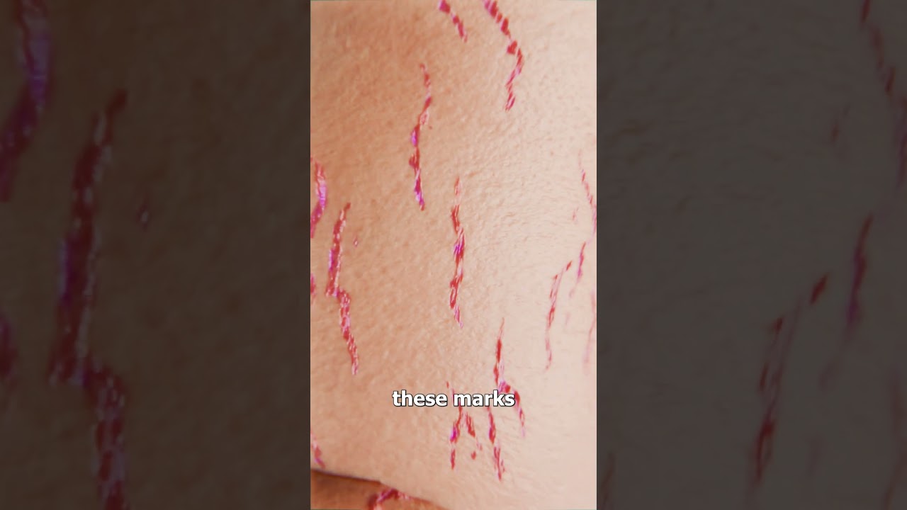 How Stretch Marks Appear 😮