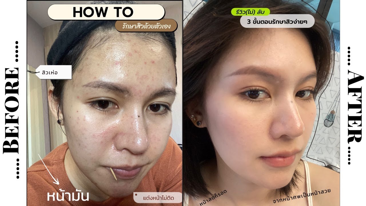How to รักษาสิวด้วยตัวเองง่ายๆ ไม่ยุ่งยากเพียง3ขั้นตอน #รักษาสิวด้วยตัวเอง