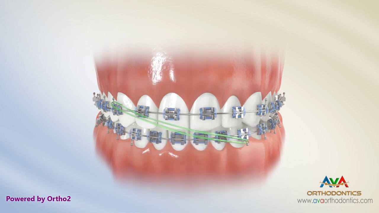 How to Wear Rubber Bands - Midline Upper 3 Lower 3