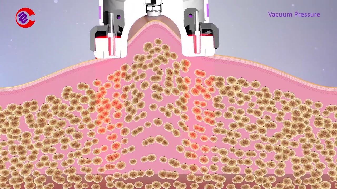 How Vacuum RF Fat Reduction Skin Tightening Treatment Work|Slimming Lymphatic Drainage Machine
