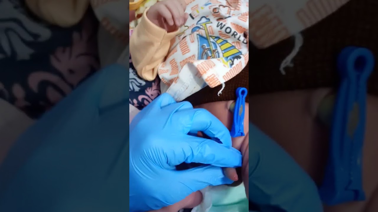 how. we examine the new born jenital erea penis and rectal opening howe we check ?