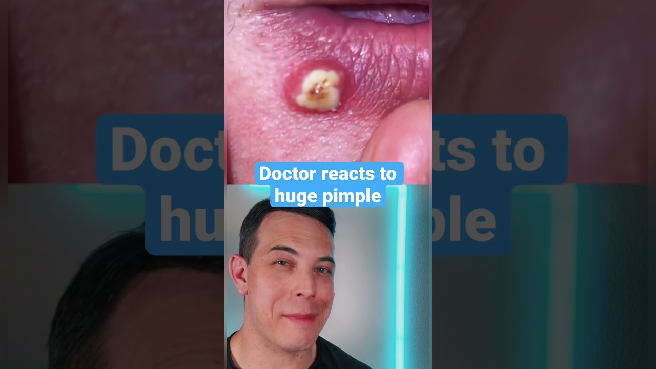 HUGE Painful Pimple on the￼ lip! | 208SkinDoc
