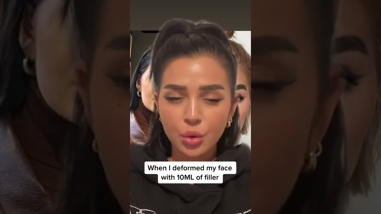 I went filler blind after having 10 injections and it deformed my face
