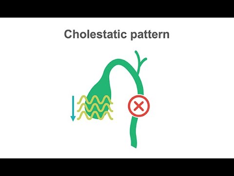 Identifying cholestasis on your liver labs panel