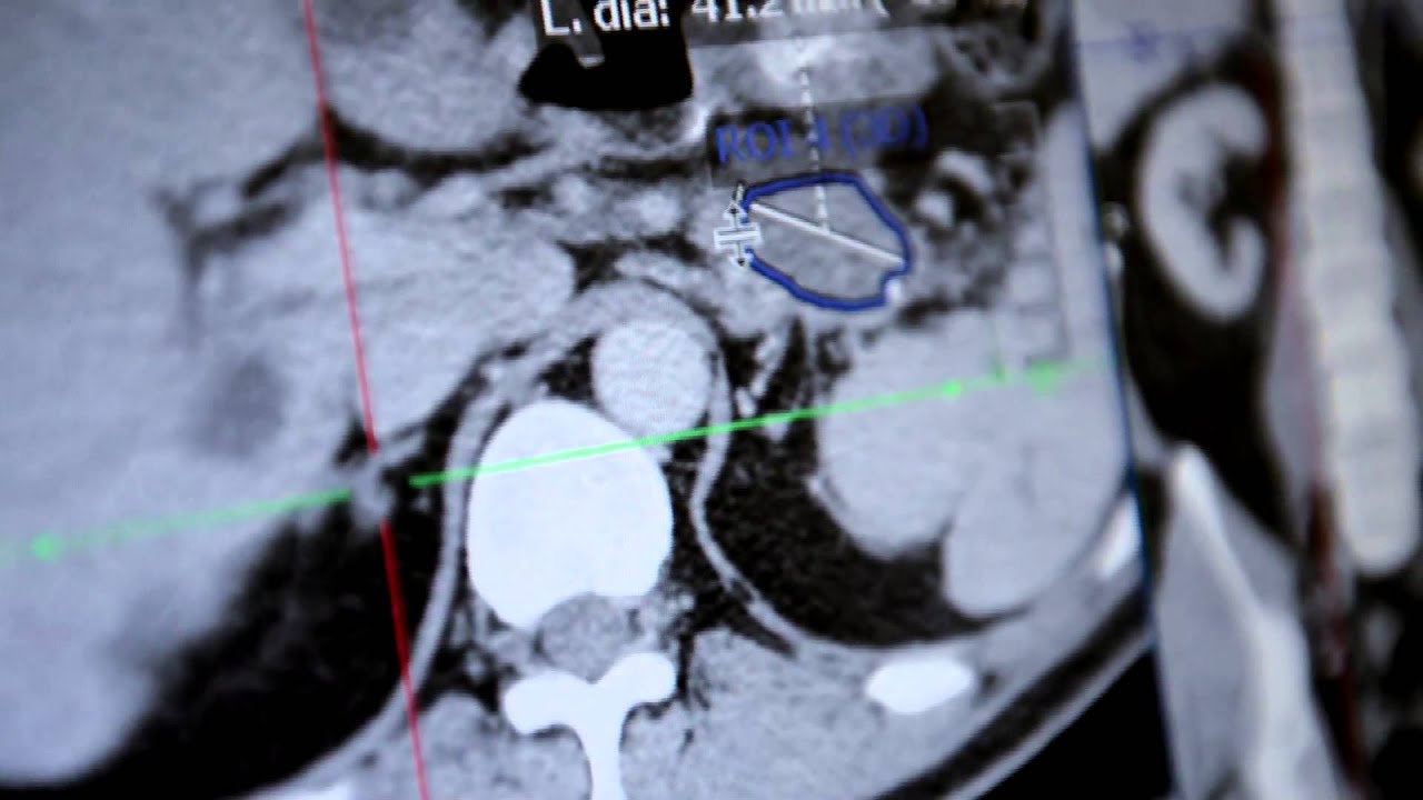 Imaging Endpoints - Connecting Imaging to the Cure