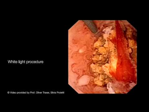 Inflammation around Impacted Stone