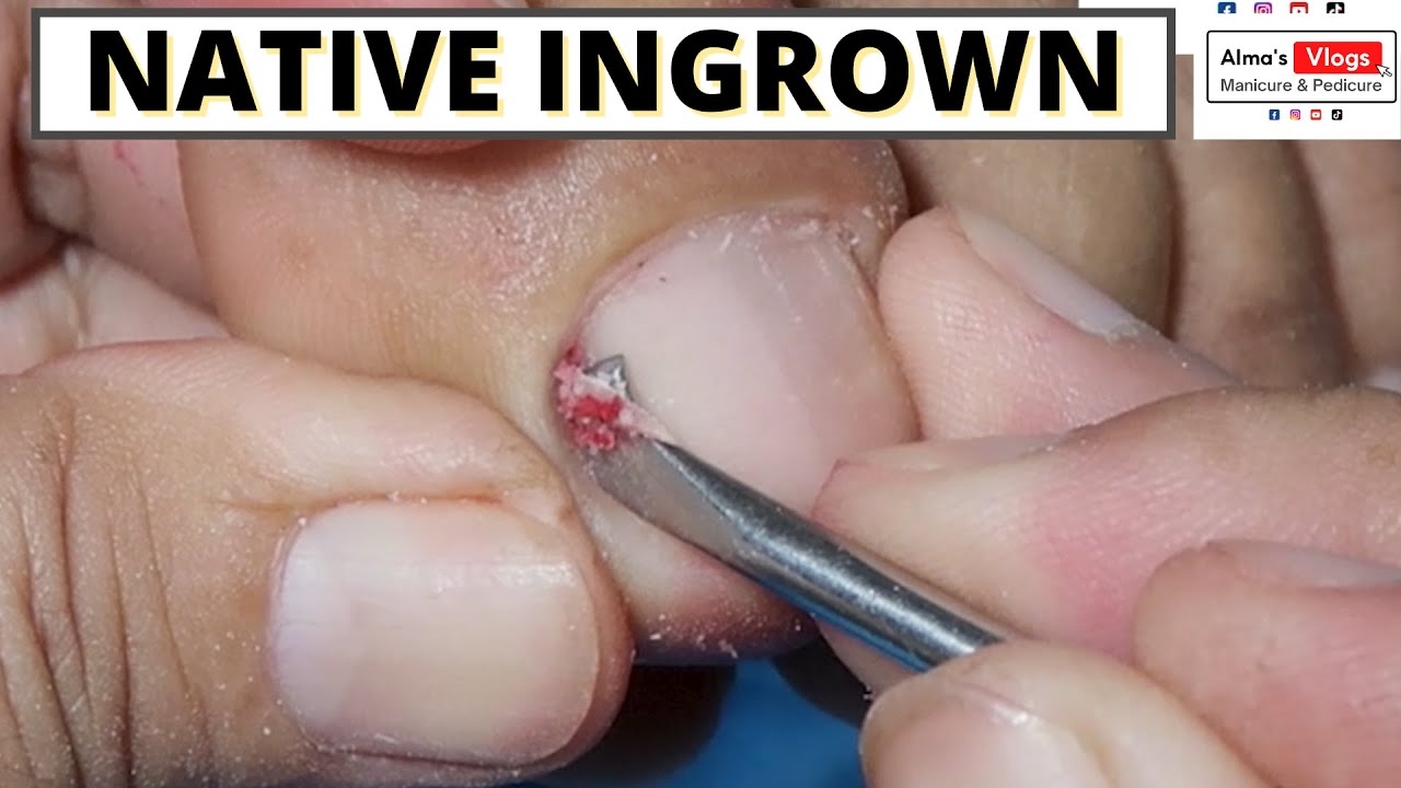 Ingrown Toenails Treatment-Alma's Manicure and Pedicure Vlogs-Joyful Initial Result