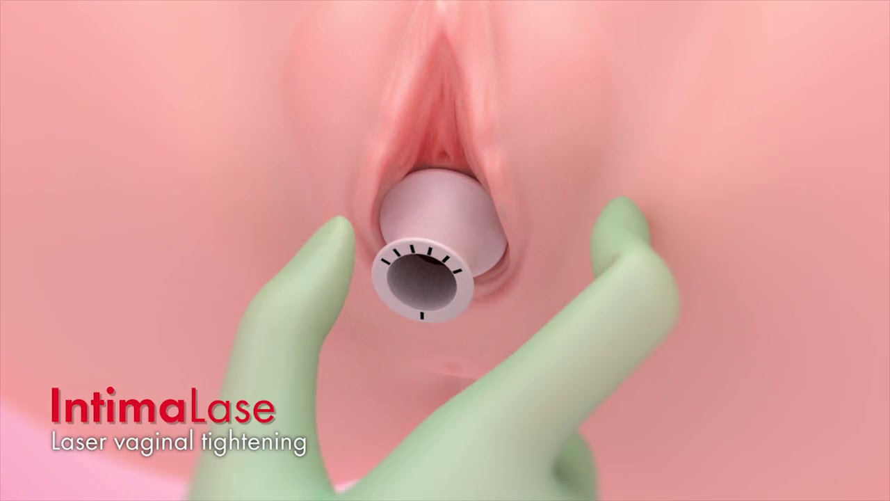 IntimaLase®