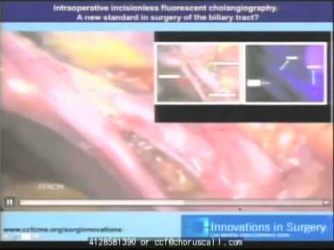 Intraoperative Incisionless Fluorescent Cholangiography -- Ep 16