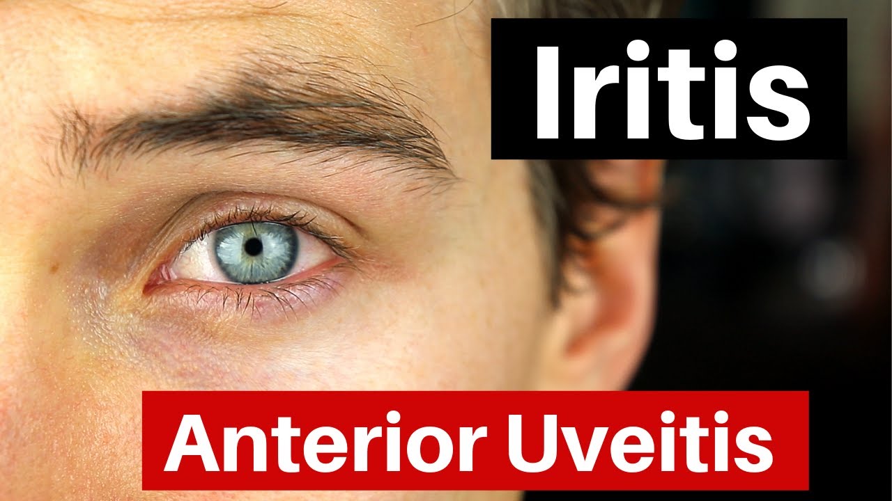 Iritis - What is Anterior Uveitis? Doctor Explains