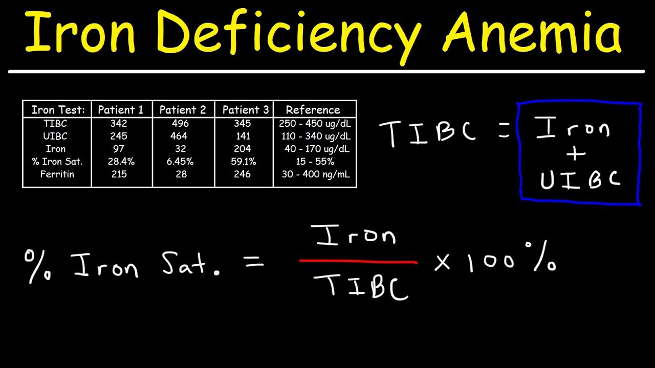 Iron Deficiency Anemia - TIBC, UIBC, Iron Saturation, Transferrin & Ferritin