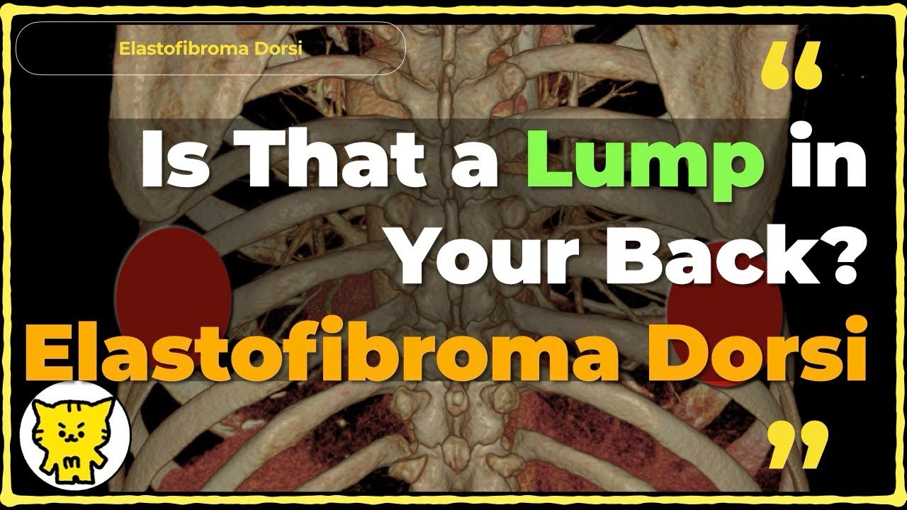 Is That a Lump in Your Back? Understanding Elastofibroma Dorsi!