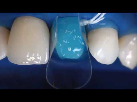 Ivoclar Vivadent Variolink N Kit (Resin Cement)  -How To Use - DENTBEAR
